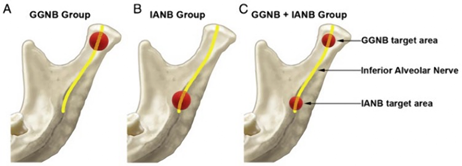 Figure 1. A schematic illustration of the injection target areas in the 3 groups: (A) 3.6 mL, (B) 3.6 mL, and (C) 1.8 mL of anesthetic solution was deposited at each of the injection target areas.