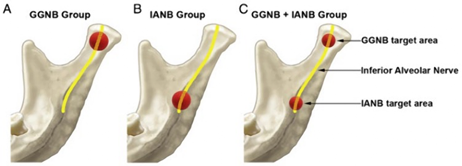 The Mandibular Nerve Block Anatomy The mandibular