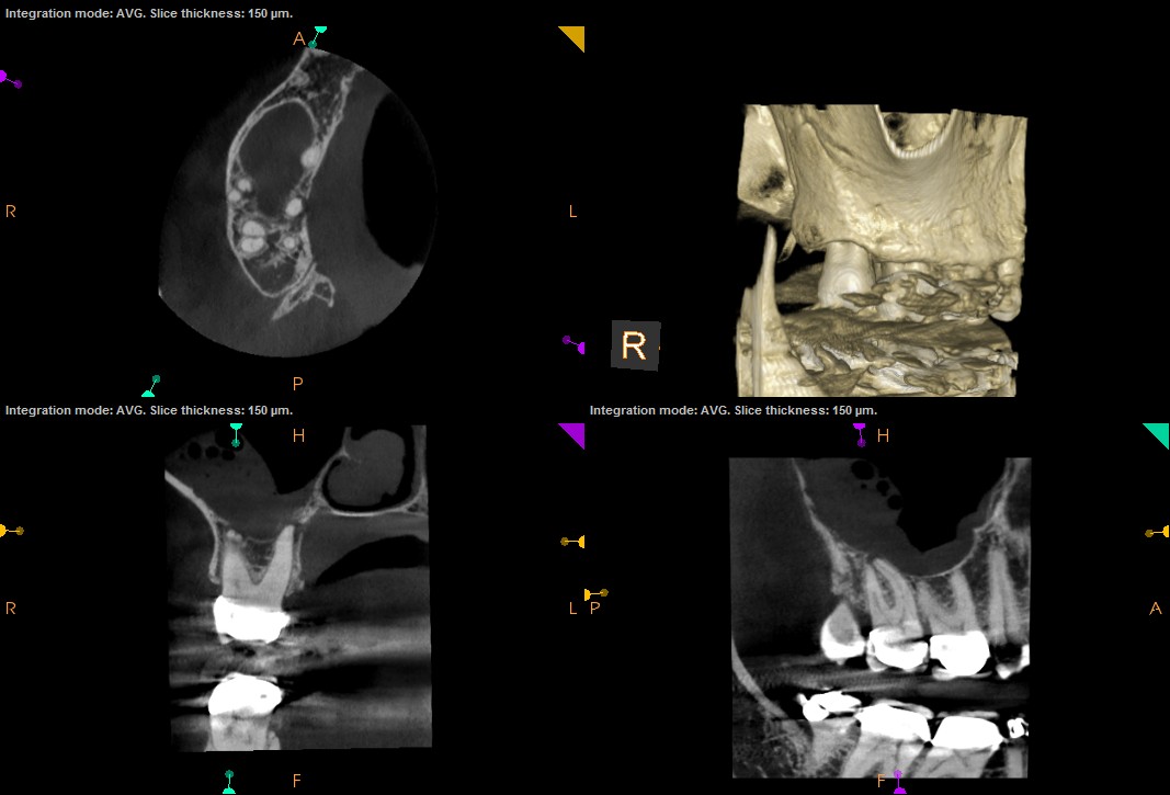 External Resorption Vs Internal Resorption