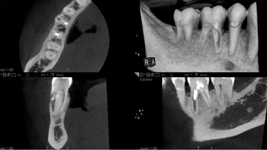 CBCT was used to diagnose and guide treatment of an external resorptive defect.