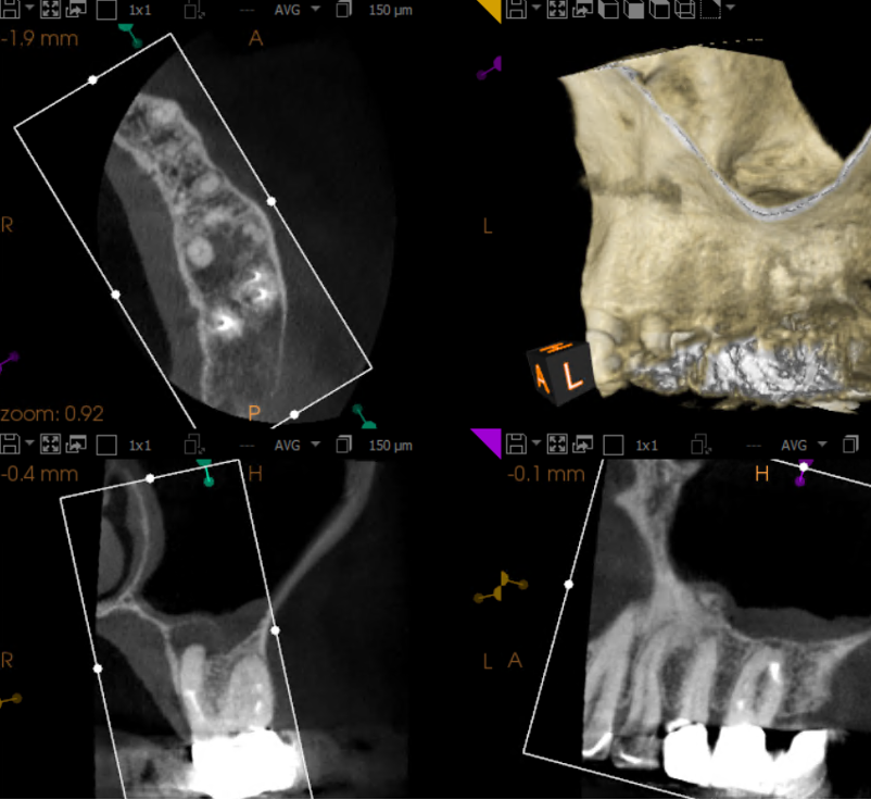 CBCT image of root canal retreatment