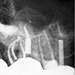 completion image of root canal retreatment