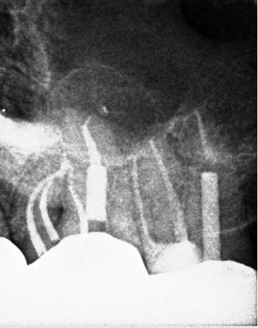 completion image of root canal retreatment