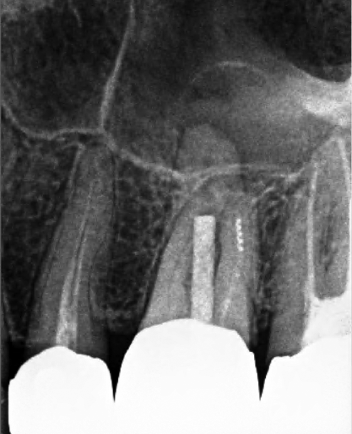 pre-op image of root canal retreatment