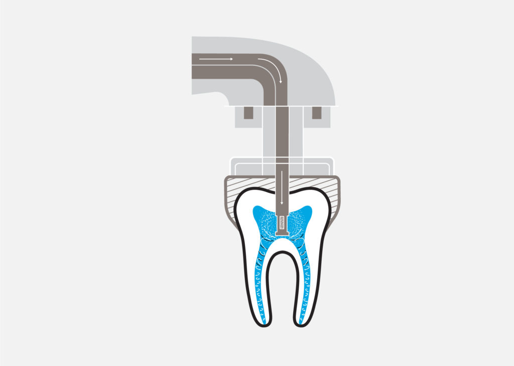 Fluids are delivered into the tooth using acoustic energy that travels through the root canal system, propelling fluids into hard-to-reach spaces, resulting in maximum cleaning.