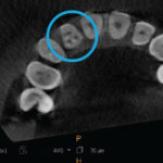 CBCT atypical anatomy