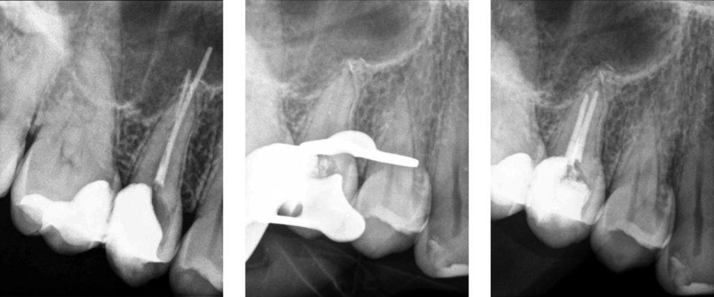 endodontic-retreatment