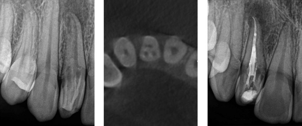 (Left) Pre-Op (Center) CBCT Axial View (Right) Post-Op