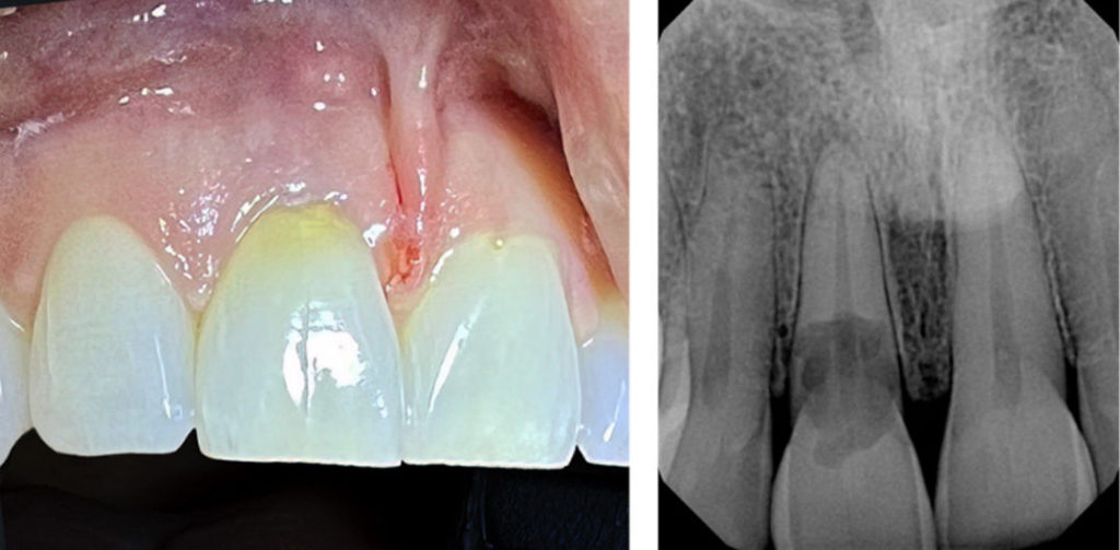 Large external resorptive defect, involving the pulp with apical lesion and bony fenestration.