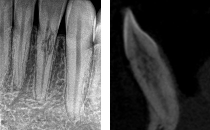 Conservative Endodontic Treatment for Cervical Invasive Resorption ...