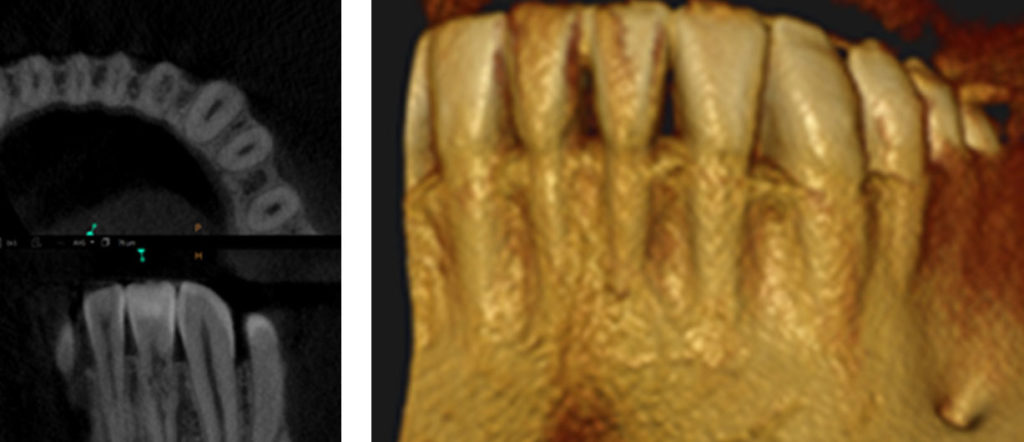 Conservative Endodontic Treatment for Cervical Invasive Resorption ...