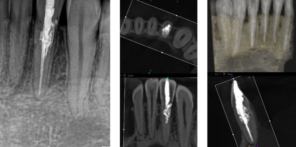 Conservative Endodontic Treatment for Cervical Invasive Resorption ...