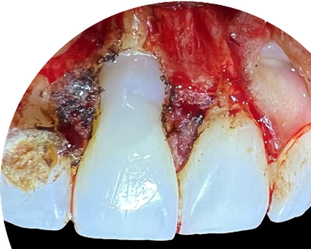 After root canal and surgical repair with Geristore.