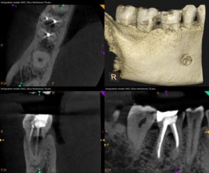 CBCT