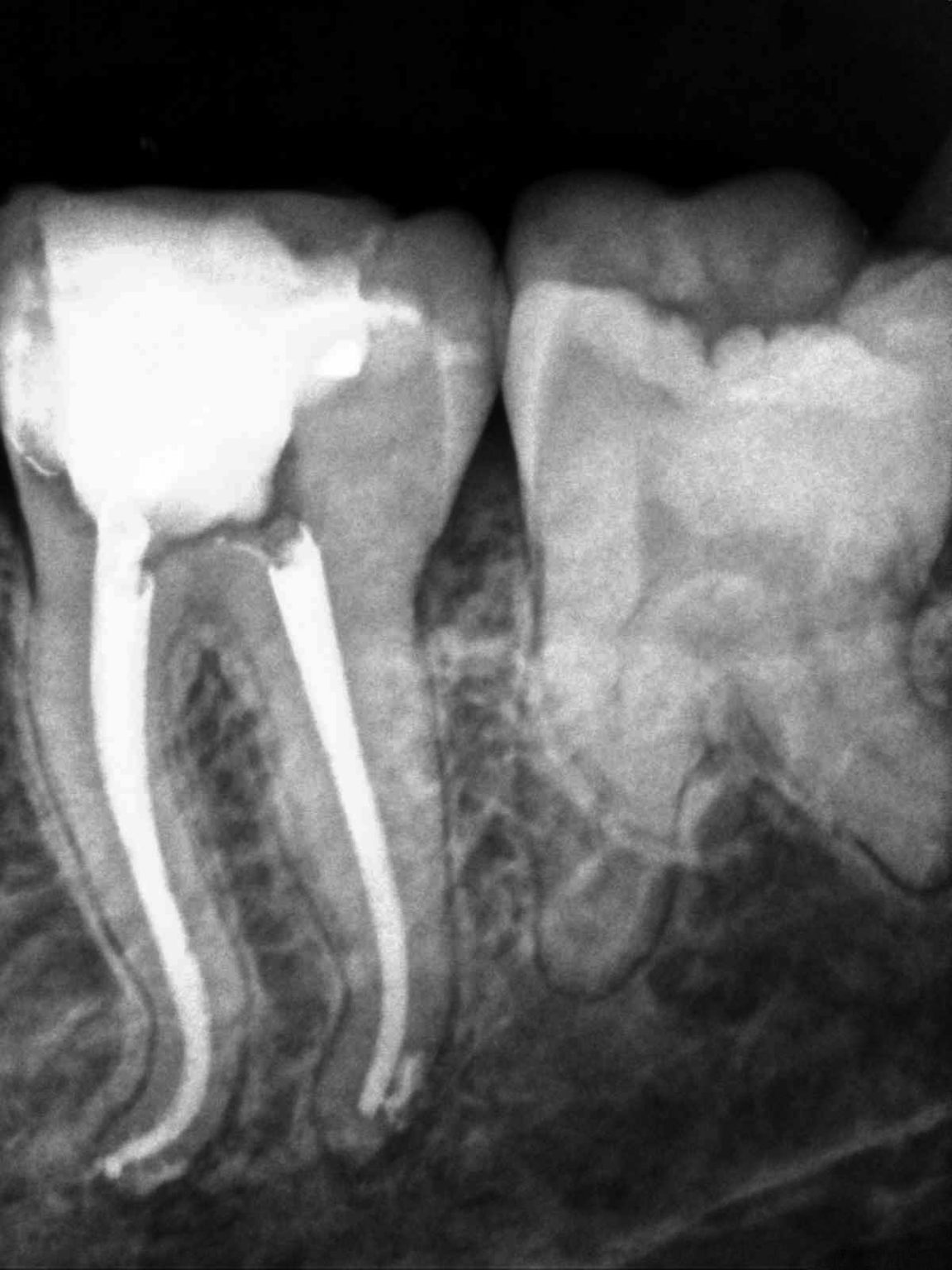 Conventional endodontic therapy of a mandibular second molar with