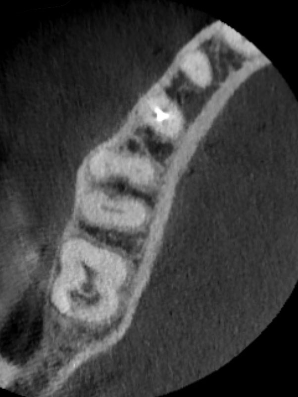 CBCT Axial Slice