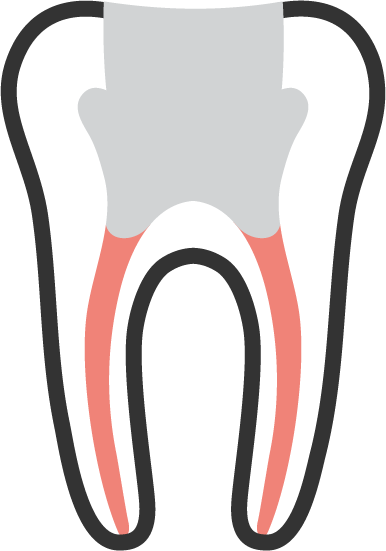 root-canal-retreatment-03