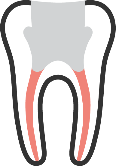 root-canal-treatment-03