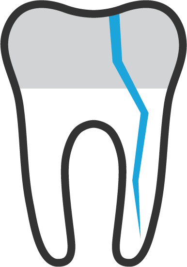 split-tooth