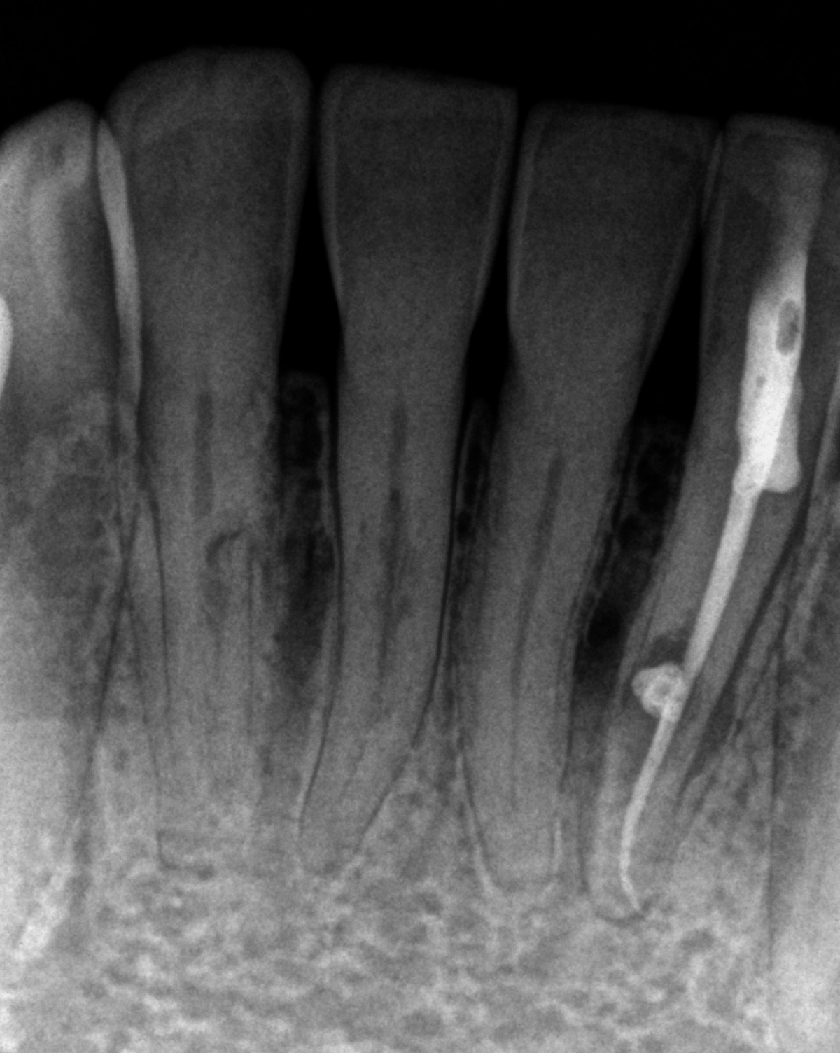 02-23-24-25-1st-post-op-01 Post-op